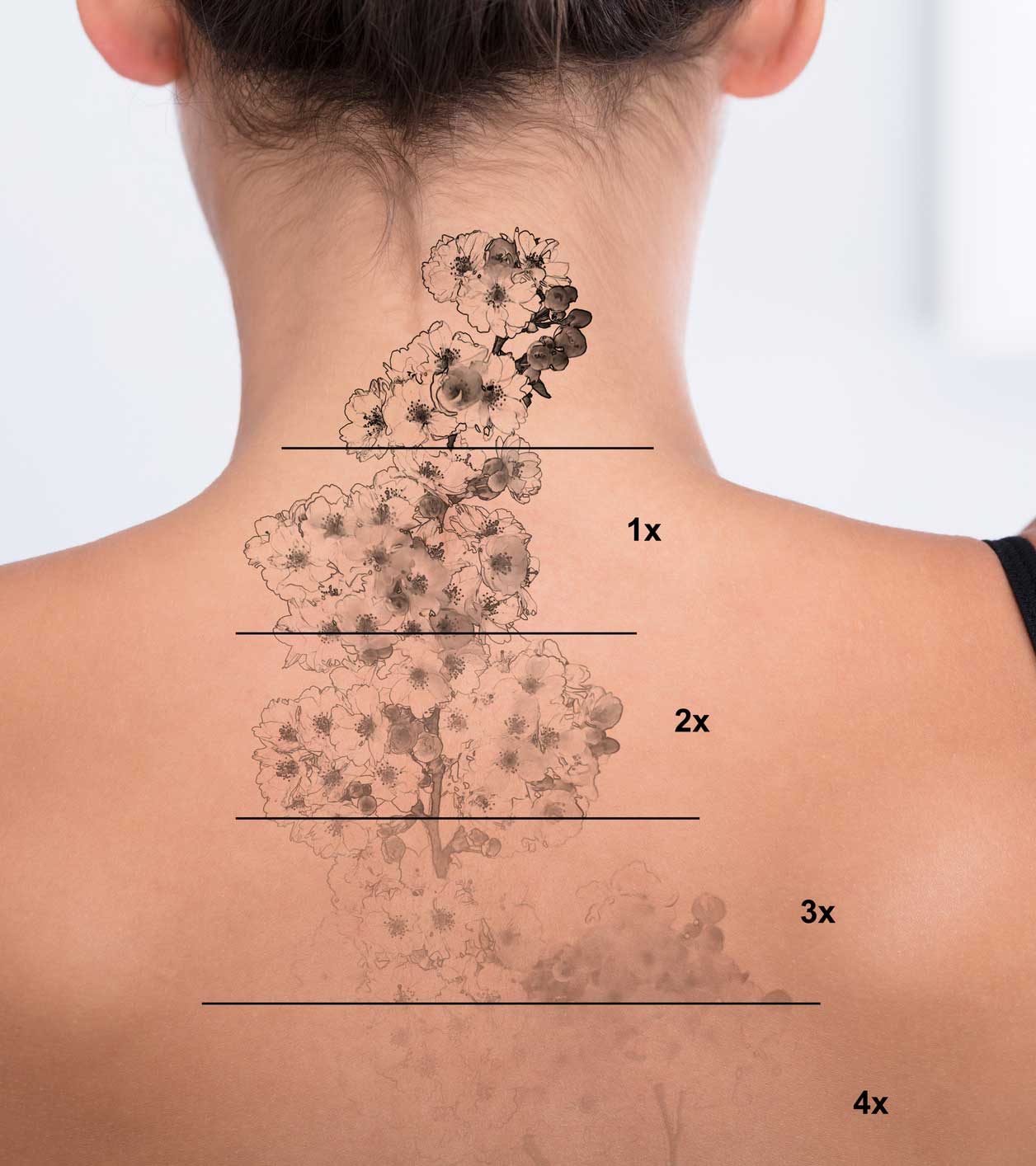 Pico Laser and the growing popularity of Tattoo removal !
