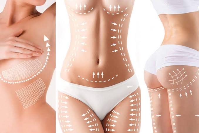 LIPOSCULPTING