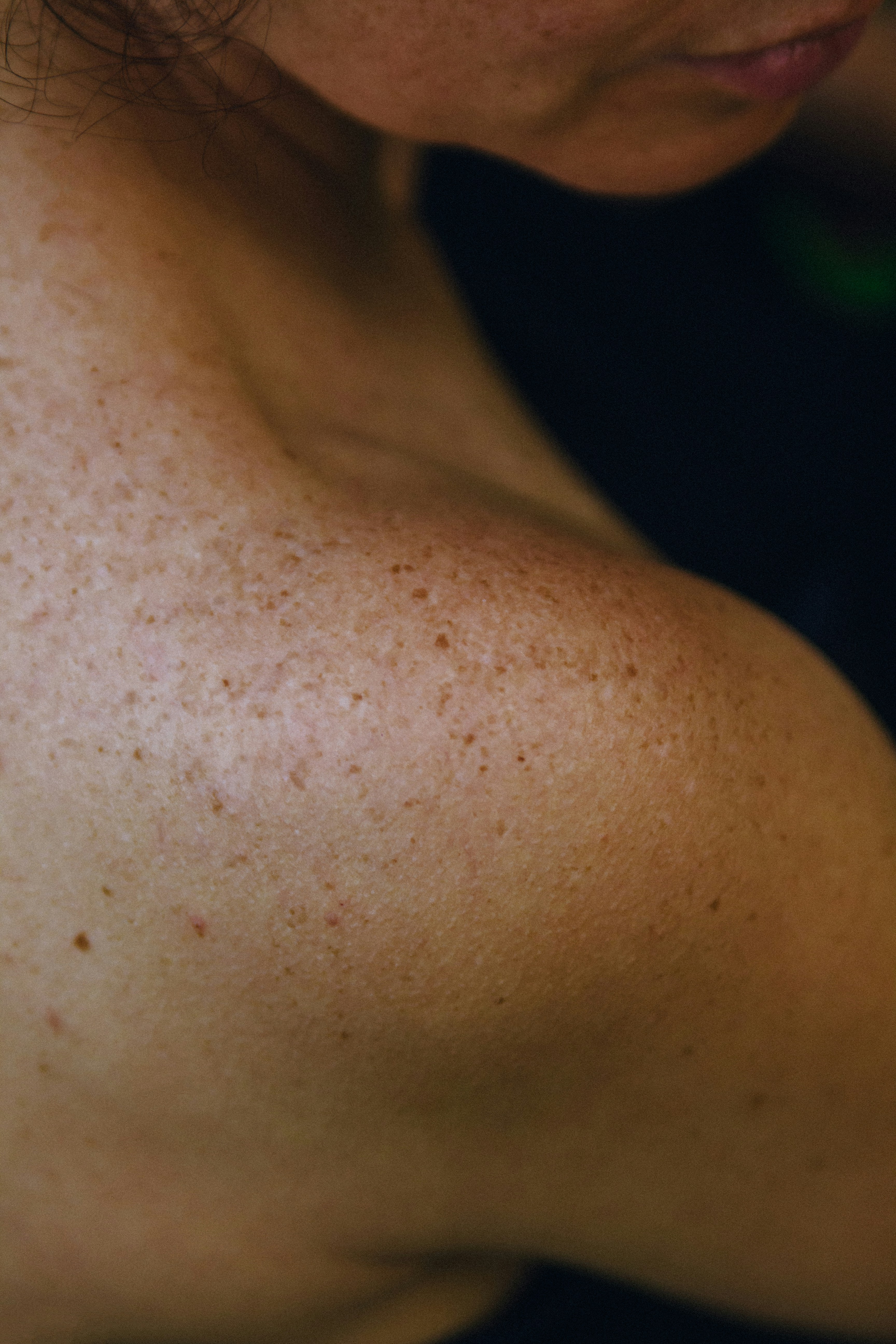 SKIN CANCER AND MELANOMA