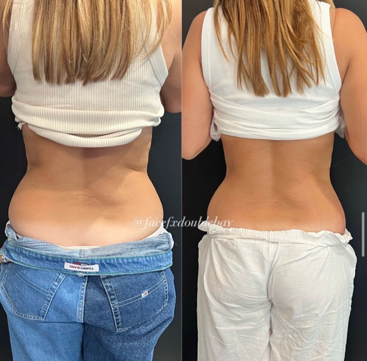 Lower Back Sculpting