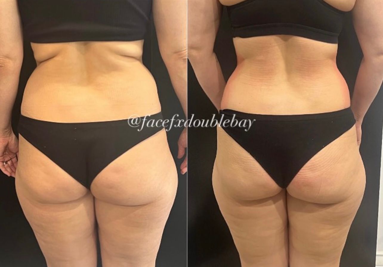 Waist & Hip Contouring