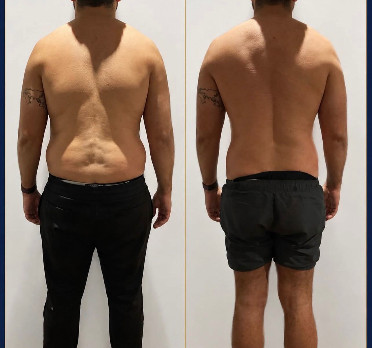 Back & Waist Contouring
